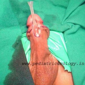Distal penile hypospadias