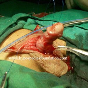 A child with Severe Hypospadias