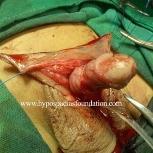 A child with Severe Hypospadias