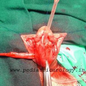 Distal penile hypospadias