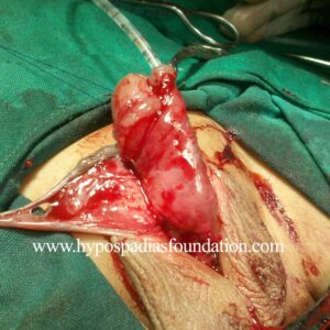 A child with Severe Hypospadias
