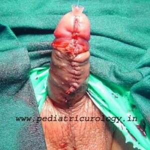 Distal penile hypospadias
