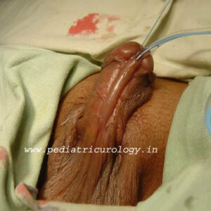 5 Hypospadias with thin urethra