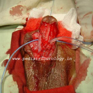 6 Hypospadias with thin urethra