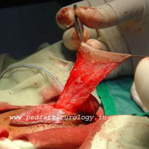 7 Hypospadias with thin urethra