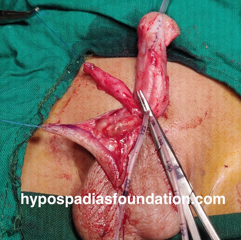 Oral mucosa graft urethroplasty surgery for hypospadias is reserved for cases where multiple surgeries have failed and there is no normal hairless skin left for urethral repair. In expert hands, staged buccal graft surgery repair has excellent results and outcomes with minimal complications. While sometimes the graft can be done in a single stage, especially if the length is very short, in most cases, a staged repair is necessary due to significant scarring and unhealthy tissues. It is preferable to remove all unhealthy tissues and then use healthy mucosa from the mouth, allowing it to heal for six months before performing the urethroplasty. Dr A.K.Singal at Hypospadias Foundation, Navi Mumbai, India, is an expert hypospadias surgeon who achieves successful outcomes in complex hypospadias repairs with fewer complications.