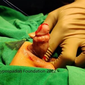 11 (3) Three-Stage Hypospadias Repair