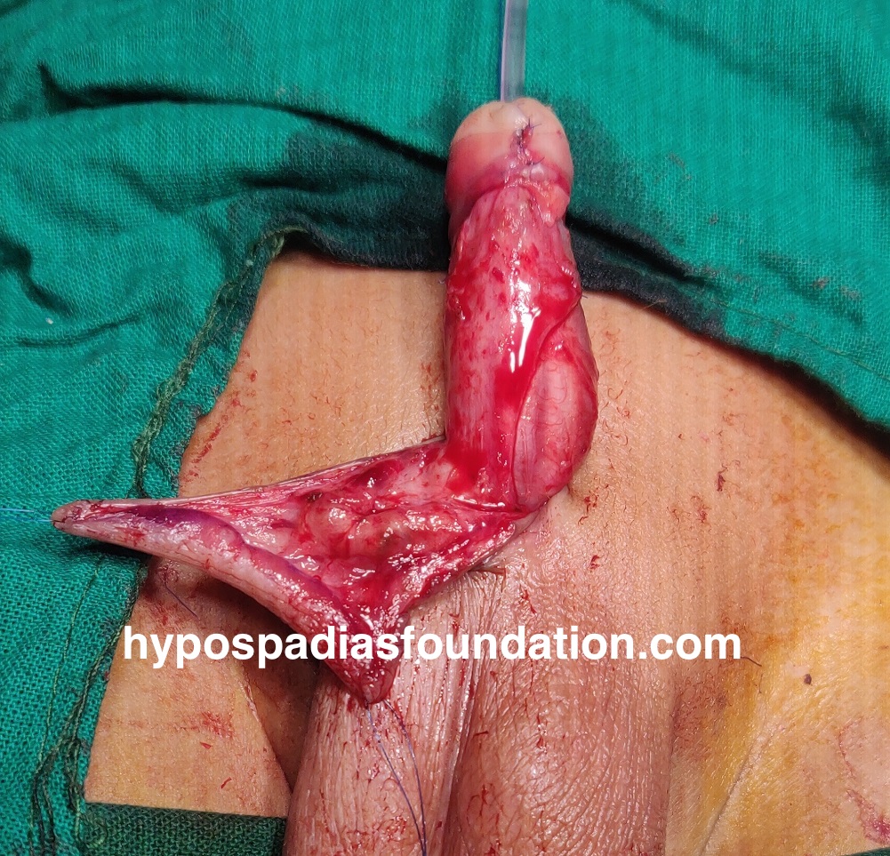 Oral mucosa graft urethroplasty surgery for hypospadias is reserved for cases where multiple surgeries have failed and there is no normal hairless skin left for urethral repair. In expert hands, staged buccal graft surgery repair has excellent results and outcomes with minimal complications. While sometimes the graft can be done in a single stage, especially if the length is very short, in most cases, a staged repair is necessary due to significant scarring and unhealthy tissues. It is preferable to remove all unhealthy tissues and then use healthy mucosa from the mouth, allowing it to heal for six months before performing the urethroplasty. Dr A.K.Singal at Hypospadias Foundation, Navi Mumbai, India, is an expert hypospadias surgeon who achieves successful outcomes in complex hypospadias repairs with fewer complications.