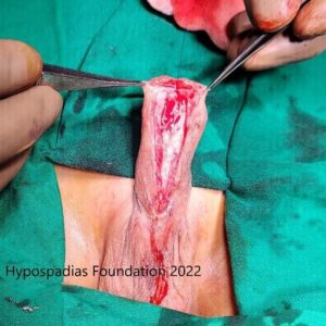 12 (2) Three-Stage Hypospadias Repair