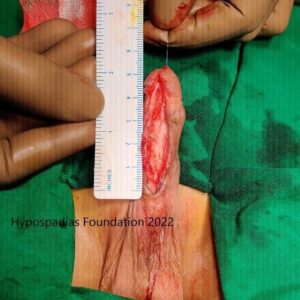 13 (1) Three-Stage Hypospadias Repair