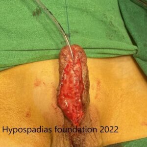 17 Three-Stage Hypospadias Repair