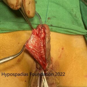 18 Three-Stage Hypospadias Repair