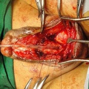 2 Staged Buccal Graft Surgery repair