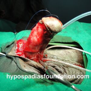 2 (5) Primary Hypospadias repair surgery in an adult