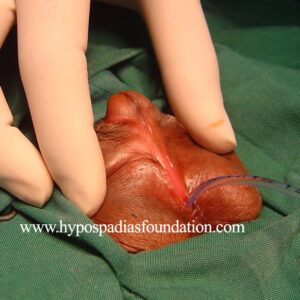 Severe Hypospadias