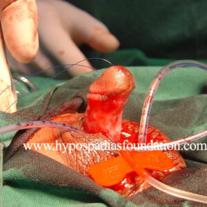 Severe Hypospadias