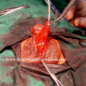 Severe Hypospadias