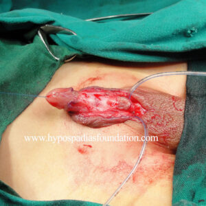 25 Severe Hypospadias needing a Staged Urethroplasty