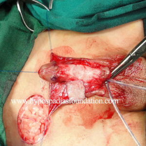 26 Severe Hypospadias needing a Staged Urethroplasty
