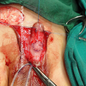 27 Severe Hypospadias needing a Staged Urethroplasty