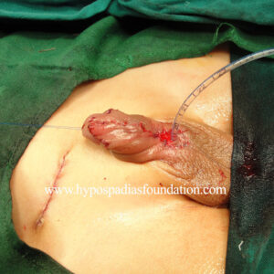 28 Severe Hypospadias needing a Staged Urethroplasty