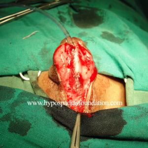 29 Severe Hypospadias needing a Staged Urethroplasty