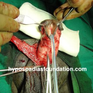 3 (4) Primary Hypospadias repair surgery in an adult