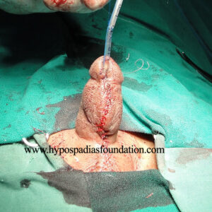 30 Severe Hypospadias needing a Staged Urethroplasty