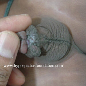 Redo Hypospadias using buccal mucosa graft