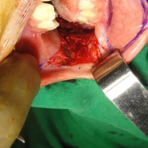 3_ Staged Buccal Graft Surgery repair