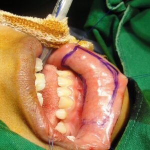 4 Staged Buccal Graft Surgery repair