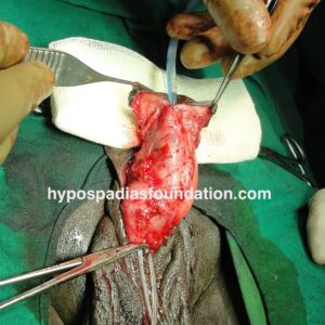 4 (4) Primary Hypospadias repair surgery in an adult