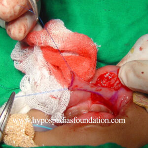 Redo Hypospadias using buccal mucosa graft