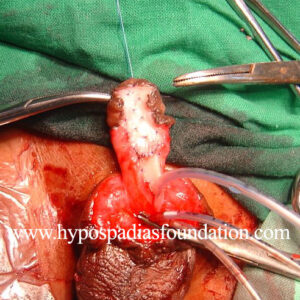 Redo Hypospadias using buccal mucosa graft