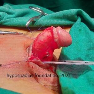 4(3) Three-Stage Hypospadias Repair