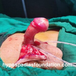 Oral mucosa graft urethroplasty surgery for hypospadias is reserved for cases where multiple surgeries have failed and there is no normal hairless skin left for urethral repair. In expert hands, staged buccal graft surgery repair has excellent results and outcomes with minimal complications. While sometimes the graft can be done in a single stage, especially if the length is very short, in most cases, a staged repair is necessary due to significant scarring and unhealthy tissues. It is preferable to remove all unhealthy tissues and then use healthy mucosa from the mouth, allowing it to heal for six months before performing the urethroplasty. Dr A.K.Singal at Hypospadias Foundation, Navi Mumbai, India, is an expert hypospadias surgeon who achieves successful outcomes in complex hypospadias repairs with fewer complications.