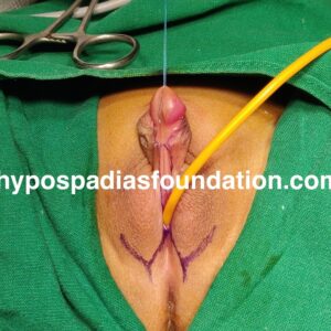 5 (2) female gender assignment surgery