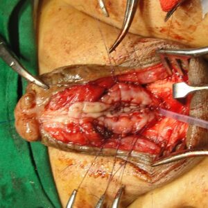 5 Staged Buccal Graft Surgery repair