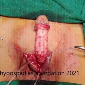 5(2) Three-Stage Hypospadias Repair