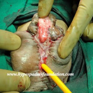 54 A 14 years old boy Hypospadias Cripple Staged reconstruction
