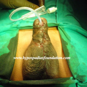 OLYMPUS DIGITAL CAMERA A 14 years old boy Hypospadias Cripple Staged reconstruction