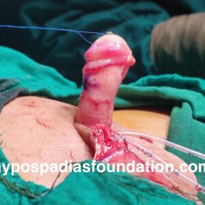 Oral mucosa graft urethroplasty surgery for hypospadias is reserved for cases where multiple surgeries have failed and there is no normal hairless skin left for urethral repair. In expert hands, staged buccal graft surgery repair has excellent results and outcomes with minimal complications. While sometimes the graft can be done in a single stage, especially if the length is very short, in most cases, a staged repair is necessary due to significant scarring and unhealthy tissues. It is preferable to remove all unhealthy tissues and then use healthy mucosa from the mouth, allowing it to heal for six months before performing the urethroplasty. Dr A.K.Singal at Hypospadias Foundation, Navi Mumbai, India, is an expert hypospadias surgeon who achieves successful outcomes in complex hypospadias repairs with fewer complications.
