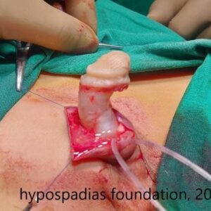6(2) Three-Stage Hypospadias Repair