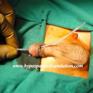 One year boy failed distal hypospadias operated