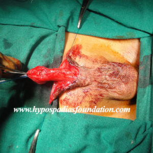 One year boy failed distal hypospadias operated