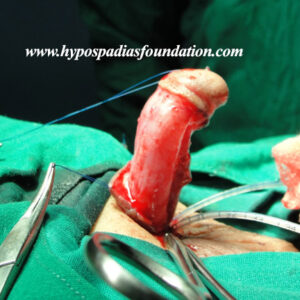 69 A 5 years old child failed hypospadias repair
