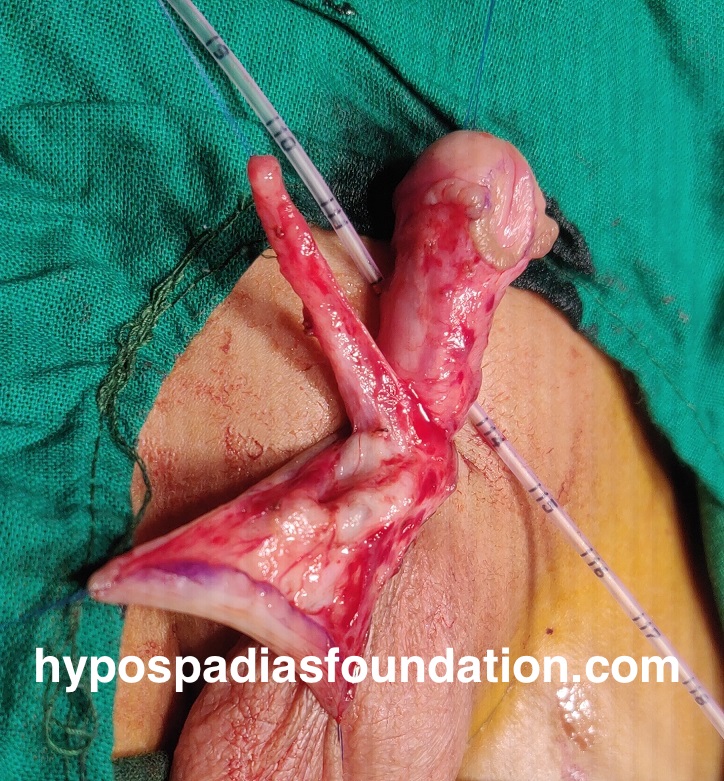 Oral mucosa graft urethroplasty surgery for hypospadias is reserved for cases where multiple surgeries have failed and there is no normal hairless skin left for urethral repair. In expert hands, staged buccal graft surgery repair has excellent results and outcomes with minimal complications. While sometimes the graft can be done in a single stage, especially if the length is very short, in most cases, a staged repair is necessary due to significant scarring and unhealthy tissues. It is preferable to remove all unhealthy tissues and then use healthy mucosa from the mouth, allowing it to heal for six months before performing the urethroplasty. Dr A.K.Singal at Hypospadias Foundation, Navi Mumbai, India, is an expert hypospadias surgeon who achieves successful outcomes in complex hypospadias repairs with fewer complications.