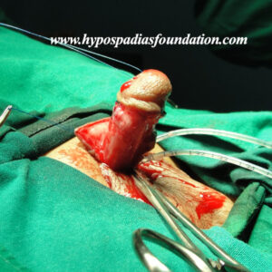 70 A 5 years old child failed hypospadias repair