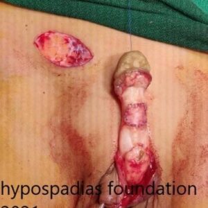 7(2) Three-Stage Hypospadias Repair