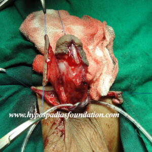 72 A 5 years old child failed hypospadias repair